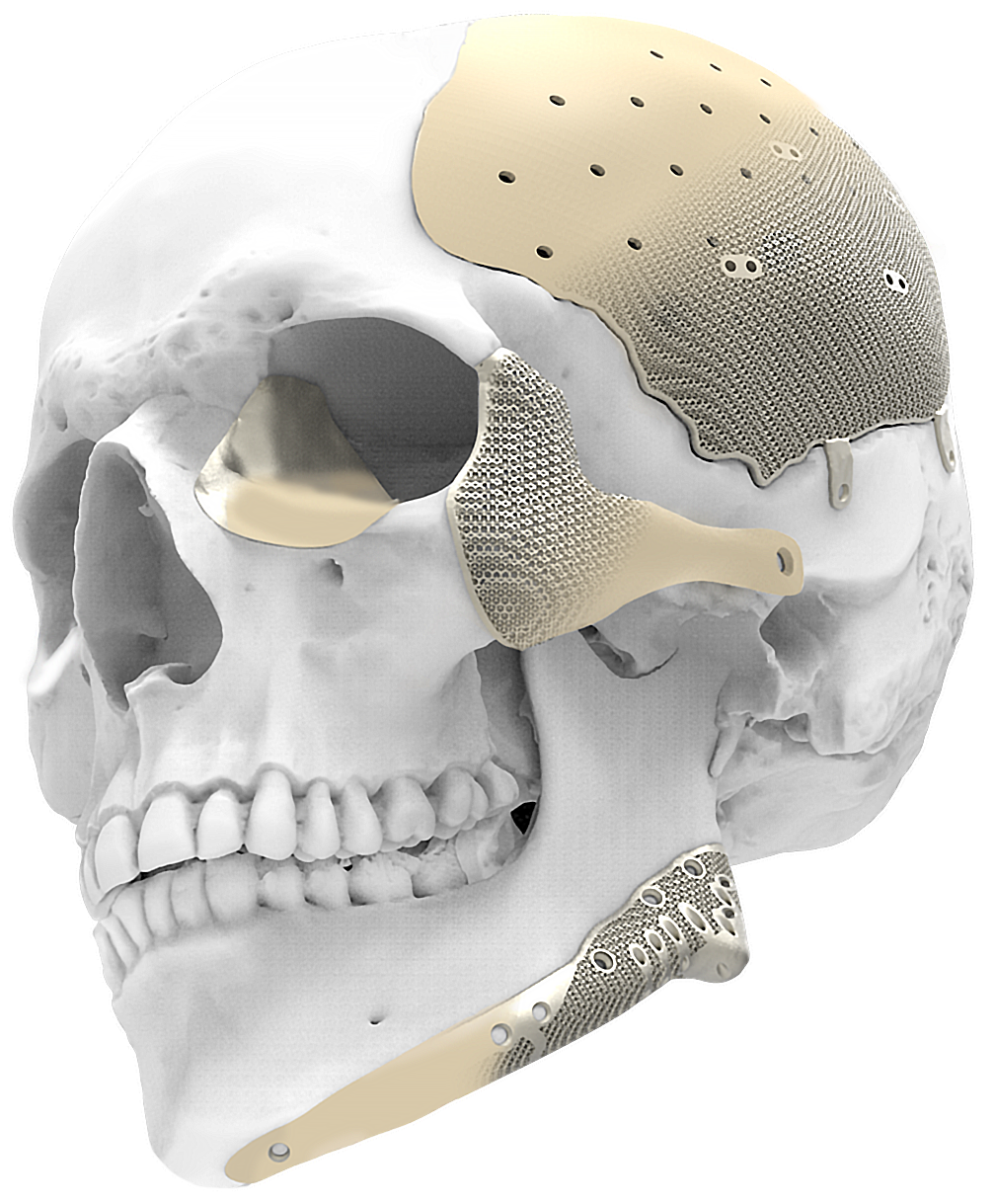 Patient-specific implant collage